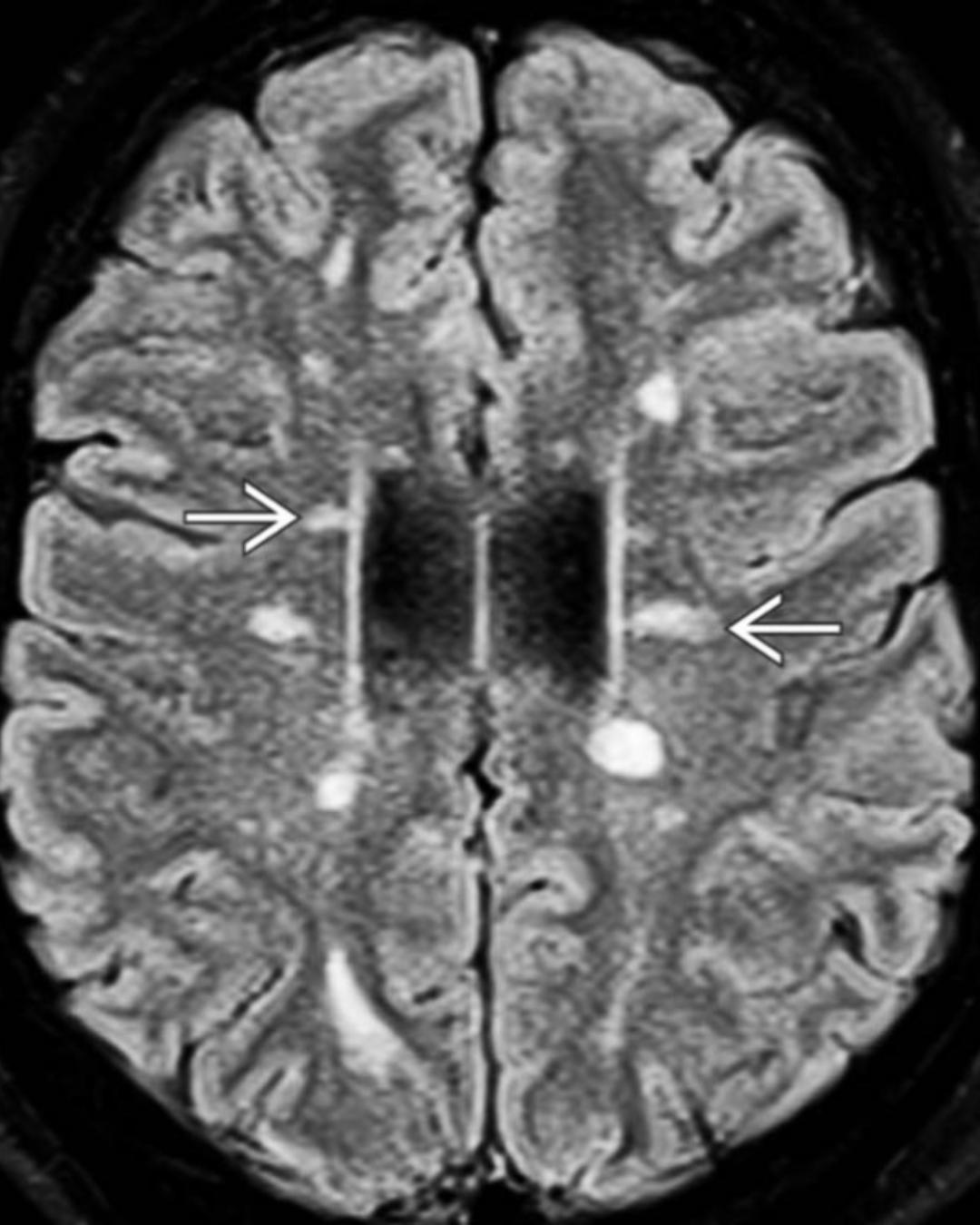 <ul><li><p>lesões adjacentes ao ventrículo lateral</p></li><li><p>dedos de Dawson → lesões ovoides perpendiculares ao ventrículo lateral</p></li><li><p>lesões sucorticais em U</p></li></ul><p></p>