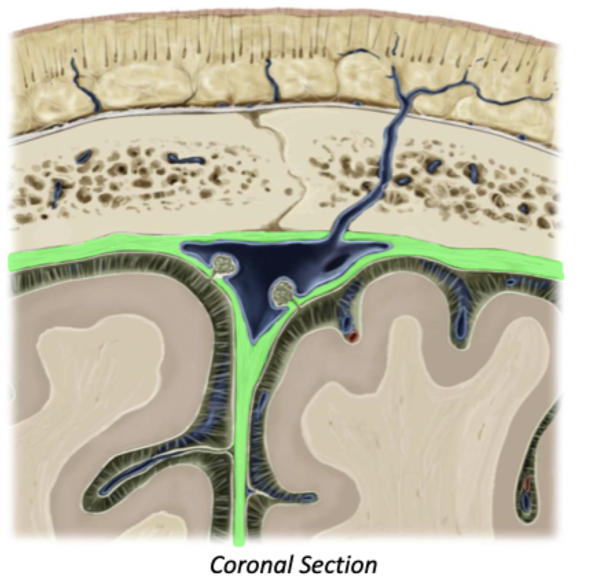 <ul><li><p>Thick layer of meninges deep to the calvarium (skull cap)</p></li><li><p>Encloses dural venous sinuses, major structures that drain the cranial vault</p></li></ul>