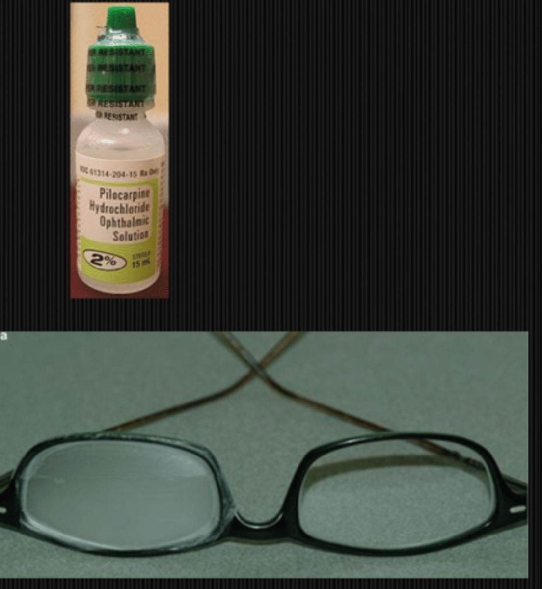 <p>eserine or pilocarpine to stimulate the CB mm (but side effects of CB spasm, HA, myopia)</p><p>OR</p><p>MF CL in affected eye</p><p>OR</p><p>occlude/frost bottom part of glasses lens to prevent binocular vision at near (induce monovision)</p>