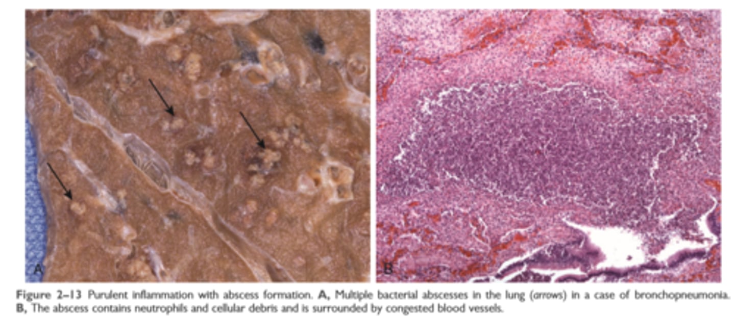 <p>These are manifested by the collection of large amounts of purulent exudate (pus) consisting of neutrophils, necrotic cells, and edema fluid</p><p>Certain organisms (e.g., staphylococci) are more likely to induce such localized suppuration and are therefore referred to as pyogenic (pus-forming)</p>