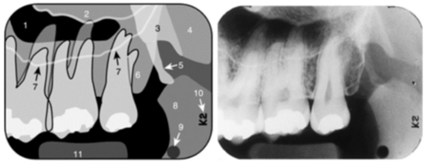 <p>Name the curved, radiopaque line that superimposes the roots of the teeth indicated by #7.</p>