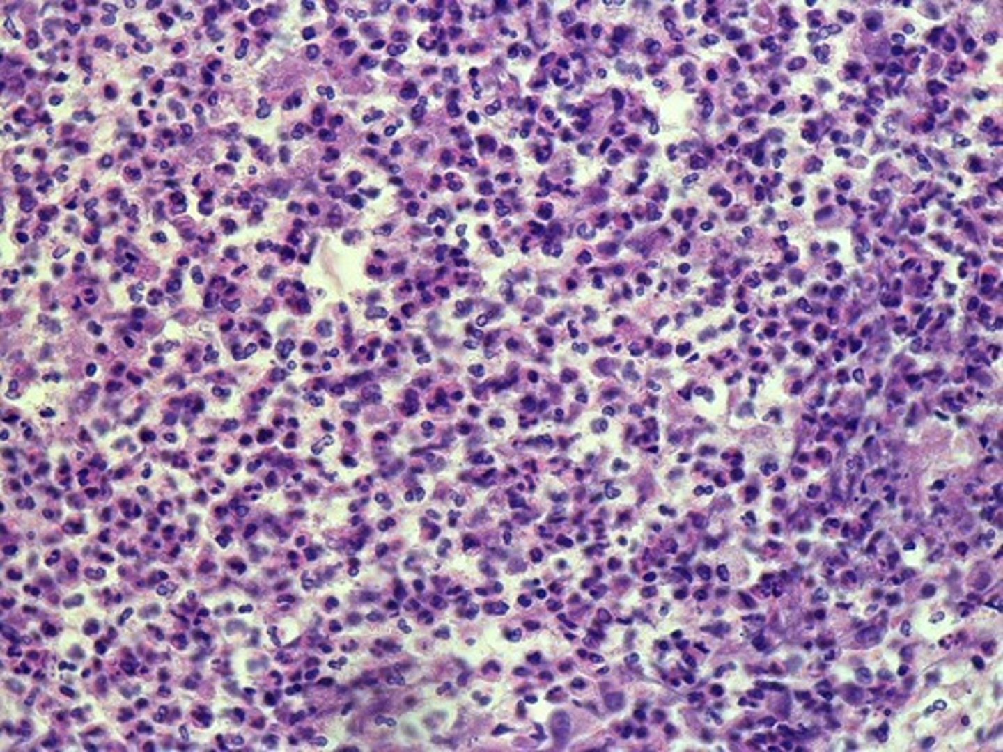 <p>Is this lung biopsy from a person with pneumonia, emphysema, or pulmonary edema?</p>