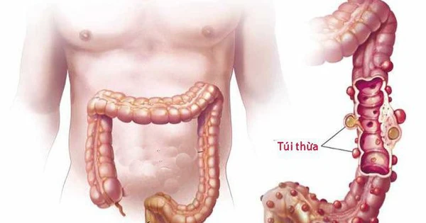 <p>viêm túi thừa</p>