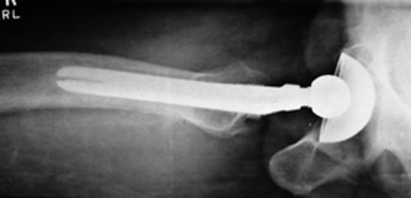 <p>- CR perpendicular to midfemoral neck</p><p>- Entire femoral head, neck, and acetabulum visualized</p><p>- No visible grid lines</p><p>- Optimal exposure factors</p><p>- Compensating filter recommended</p>