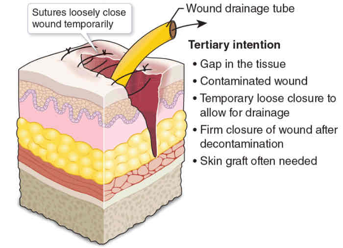 <p>Missing large amounts of deep tissue</p><p>Delayed closure due to infection or other factors</p><ul><li><p>Cleaned and left open (4-5 days)</p></li><li><p>Pack with sterile gauze</p></li><li><p>5th day</p><ul><li><p>Phagocytosis of contaminated tissue</p></li><li><p>Epithelialization</p></li><li><p>Collagen deposition</p></li><li><p>Maturation</p></li></ul></li><li><p>Prominent scarring</p><ul><li><p>Skin graft needed</p></li></ul></li></ul><p></p>