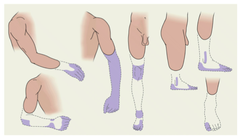sensations that appear to originate in a limb that has been amputated after an amputation, the person continues to experience the felt presence of the amputated limb. what happens is the region of the parietal lobe that normally receives signals from the amputated limb is no longer getting that input so neurons form connections with neurons in adjacent regions of the body map and because of this neuroplastic reorganization, the phantom limb is born.