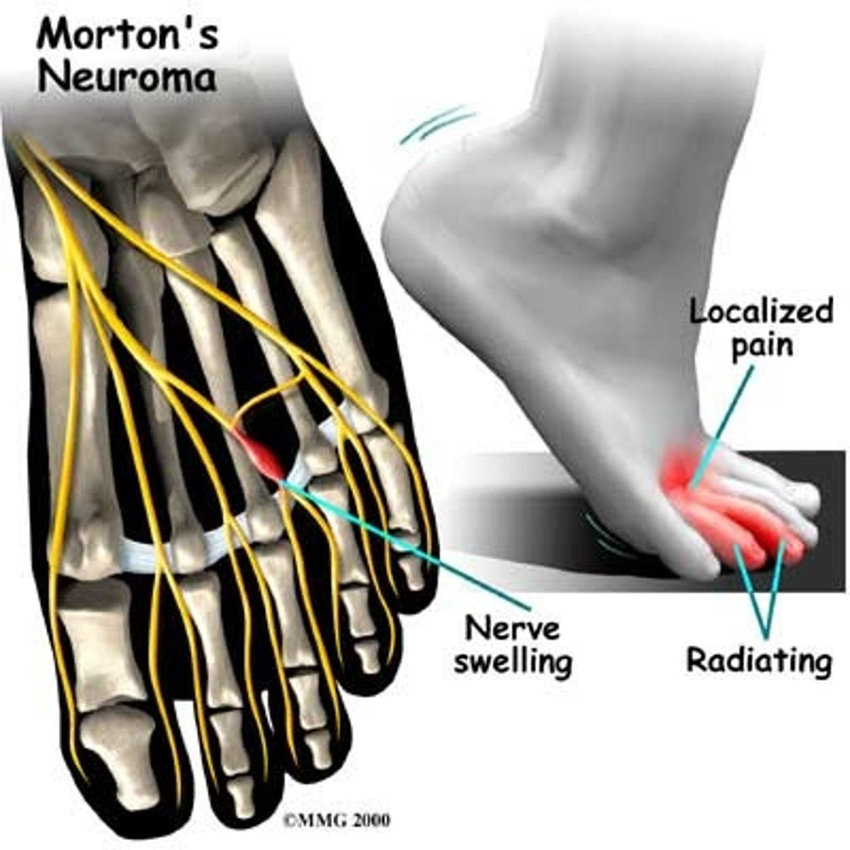 <p>compressive neuropathy of the interdigital nerve</p><p>- perineural fibrosis &amp; entrapment of the interdigital nerve, probably due to repetitive microtrauma</p>