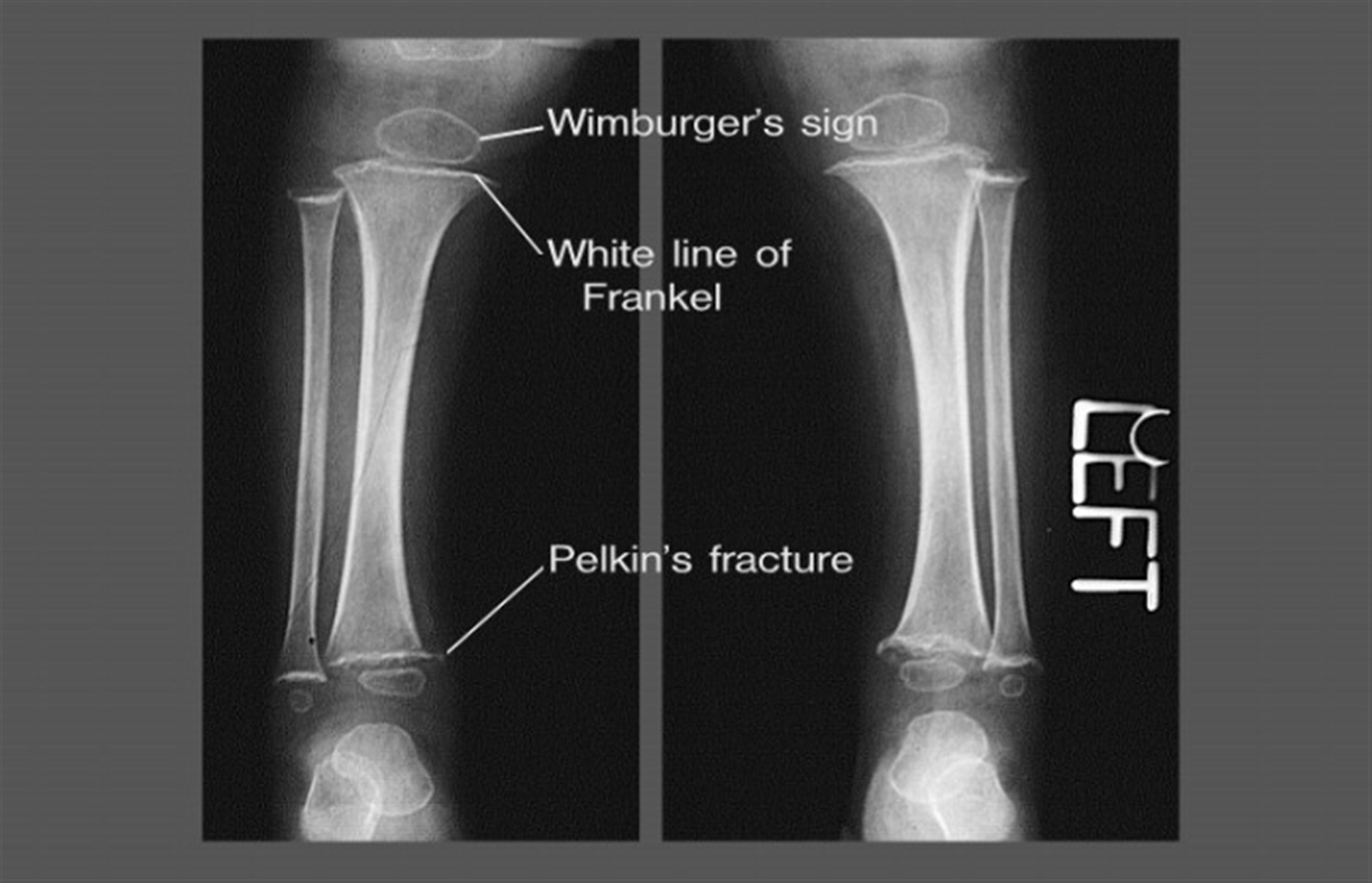 <p>What are white line of Frankel seen in?</p>