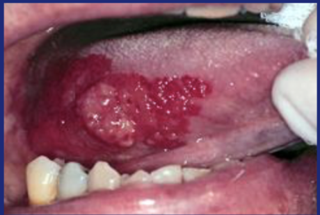 <p>‘A bright red, velvety plaque that cannot be characterised clinically or pathologically as any other recognisable condition</p>