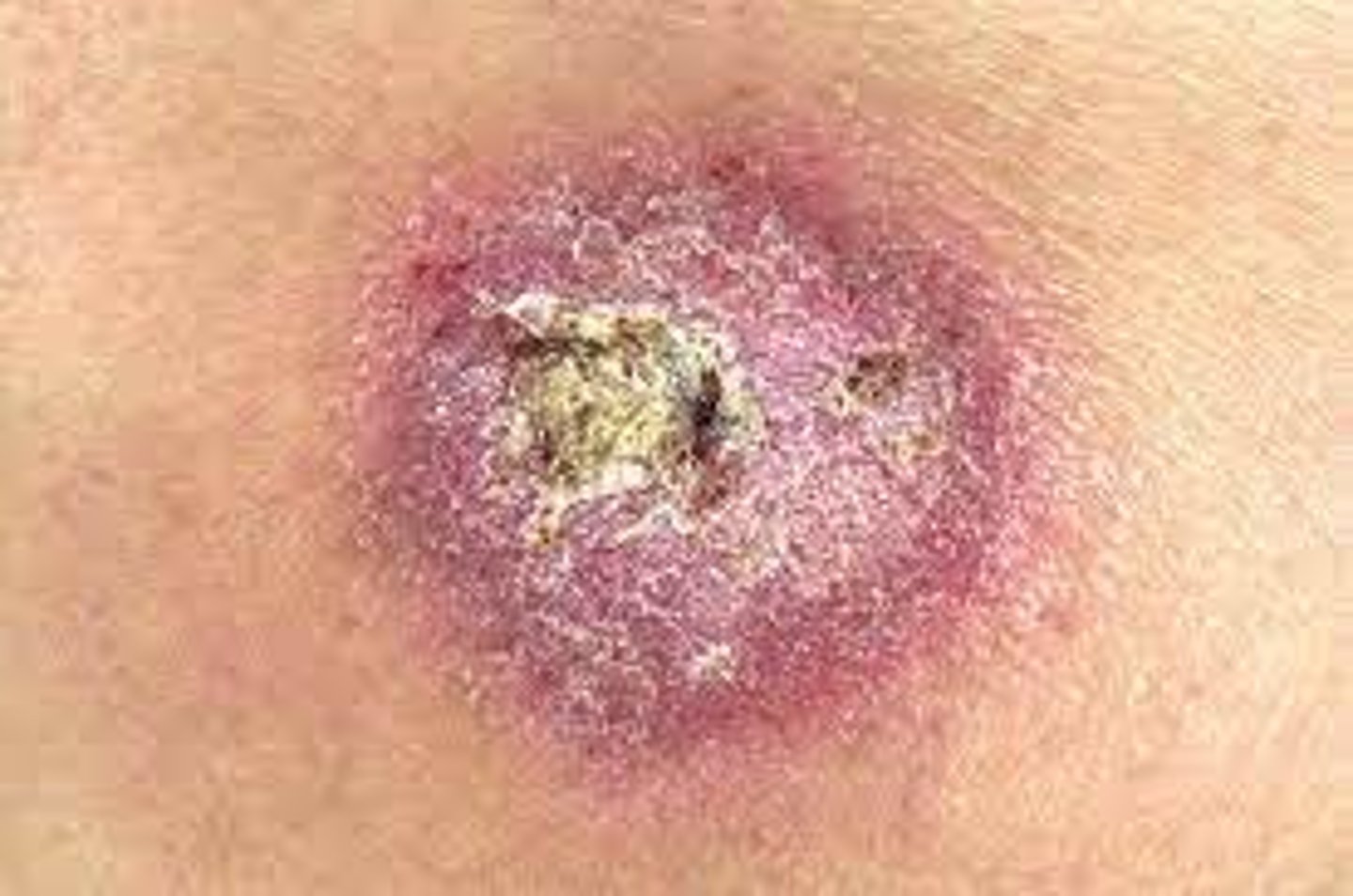 <p>-Dried drainage or blood, slightly elevated</p><p>-Varies in size and color (red, black, tan, mixed)</p><p>Example:</p><p>-Sab on abrasion</p><p>-Eczema</p>