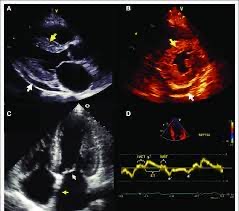 <ul><li><p>increased ventricle wall thickness</p></li><li><p>→ Ground glass or granular myocardium (sparkling appearance)</p></li><li><p>Atrial dilation (diastolic dysfunction)</p></li><li><p>Pericardial/pleural effusion</p></li><li><p>Significant diastolic dysfunction</p></li><li><p>→ Altered strain pattern (apical sparing)</p></li><li><p>Thickened valves w/ regurgitation (usually mild)</p></li><li><p>Thickened IAS</p></li><li><p>Thickened papillary muscles</p></li></ul>