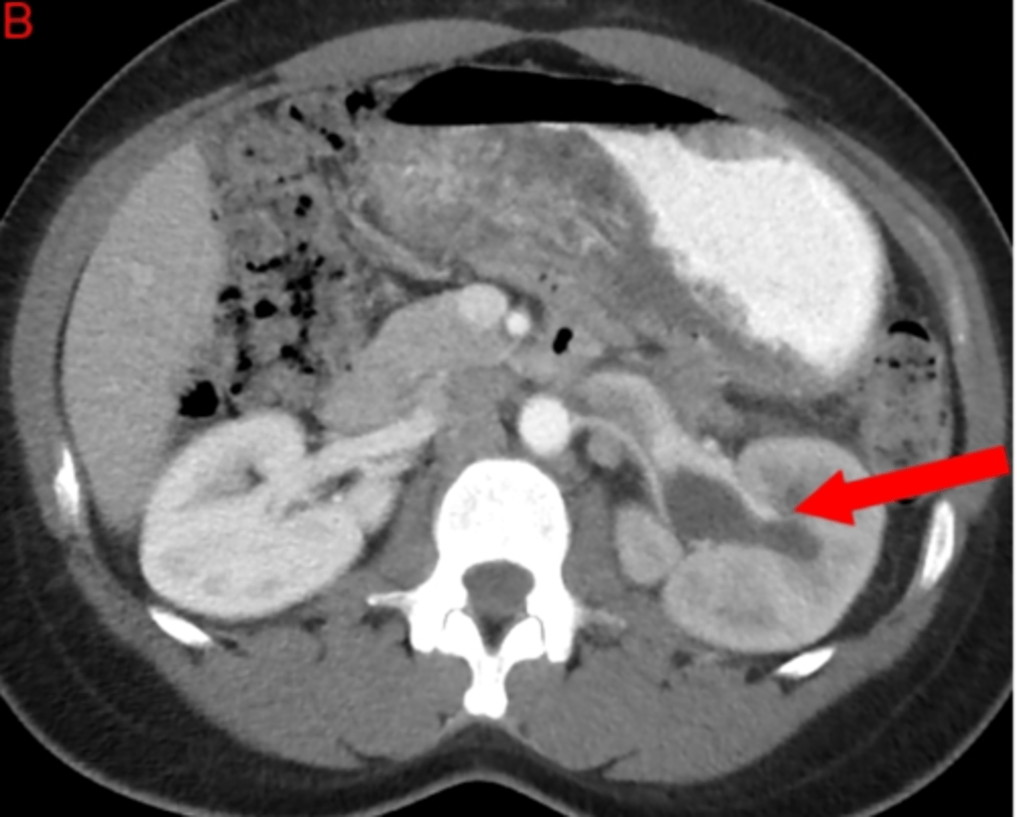 <p>Slices, high dose of radiation</p>