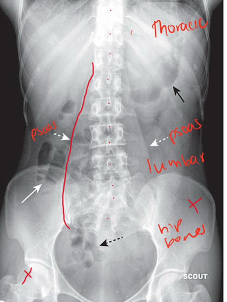 <p>psoas muscle, thoracic &amp; lumbar spine, pelvis, sacrum, hip bones</p>