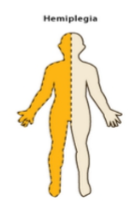 <p>Define ‘hemiplegia.’</p>
