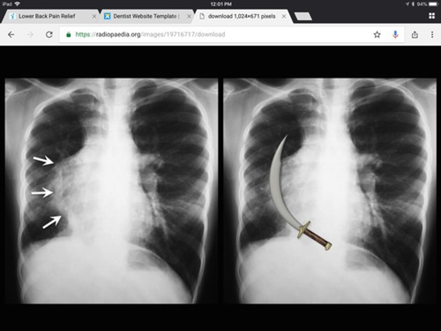 <p>rare congenital anomaly where pulmonary veins of entire right lung drain to the IVC. </p>
