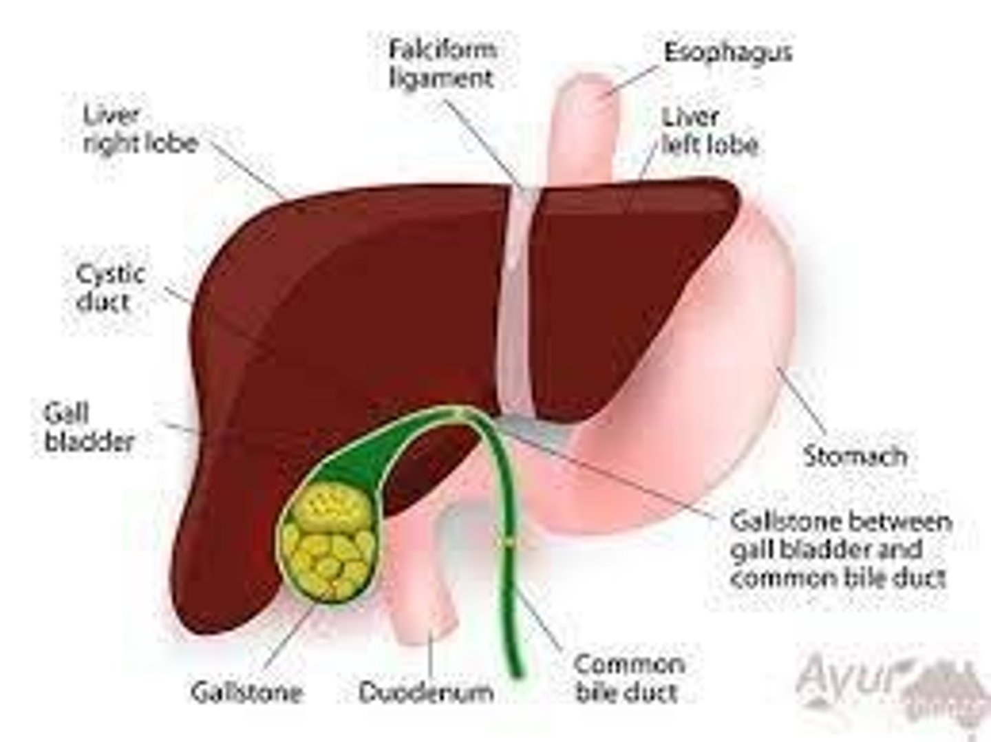 <p>Inflammation of the gallbladder.</p>
