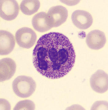 <p>These<strong> mucopolysaccharide deposits</strong> are associated with <strong>Hurler’s </strong>and <strong>Hunter’s </strong>syndrome.</p>