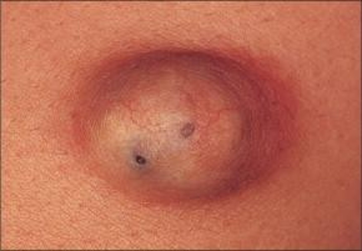 <p>primary lesion; closed, abnormally developed sac that contains pus, semi fluid or morbid matter above or below the skin</p>