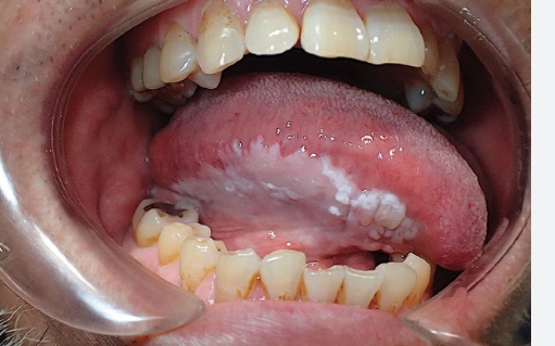 <p><span style="font-family: Droid Sans Mono, monospace">ORAL LEUKOPLAKIA</span></p>