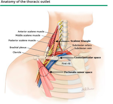 <p><strong>Thoracic Outlet Syndrome</strong></p><p>-_____________ of neurovascular structures supplying the _____ extremity </p><ul><li><p>_______ ________ is the most common</p></li><li><p>Subclavian artery and vein are the least common</p></li></ul><p>-Pathogenesis: </p><ul><li><p>Developmental abnormalities → anomalous or cervical rib, muscular anomalies </p></li><li><p>_______ → hyperextension/flexion of the neck </p></li><li><p>Predisposing physical activities </p></li></ul><p></p>