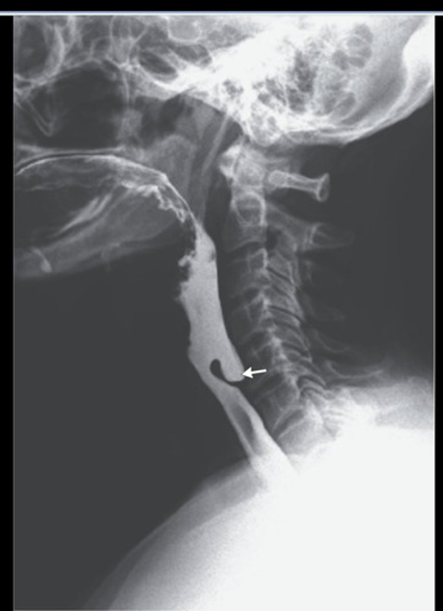 <p>outpouching of pharyngeal muscle; cricopharyngeal muscle fails to relax during swallowing</p>