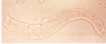 <ul><li><p>degradation of material in cast</p><ul><li><p>Crystal, RBC, WBC, RTE</p></li></ul></li><li><p>Begins as coarse and becomes fine during urinary stasis</p></li></ul><p></p>