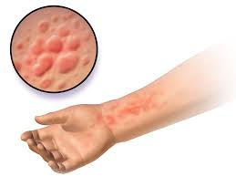 <p>PP: histamine reaction</p><p>E: idiopathic (50%)<br>mx<br>cold/heat<br>foods<br>stress<br>infections<br>menthol<br>wine (sulfites)</p><p>CM: wheal (localized edema)<br><strong>never lasts more than 24 hours</strong></p><p>severe itching/sticking/prickling sensation<br>angioedema<br>anaphylaxis<br>hypotension</p><p><u>dermatographism:</u> post scratching→raised wheal</p><p>DX: detailed hx</p><p>chronic:<br>CBC<br>LFT<br>ANA<br>thyroid screening<br>hepatitis screening</p><p>TX:<br><u>acute→within 6 weeks</u><br>self-relieving<br>antihistamines PRN</p><p><u>chronic→over 6+ weeks</u><br>NP: allergist referral</p><p>MX: injectable omalizumab x 1 month<br>antihistamines x daily (linked to dementia)<br><strong>no topical steroids</strong></p>