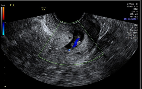 <p>Leiomyomas and cervical polyps are best visualized with _________</p>