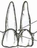 <p>Driehoekige ruimte onder contactpunt. In normale omstandigheden wordt deze opgevuld dr tandvleespapil.</p>