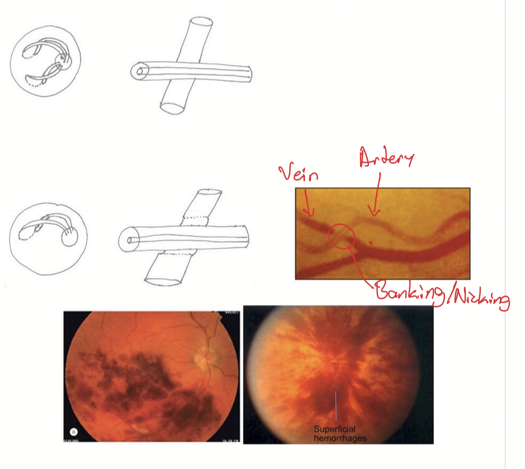 <ol><li><p>HTN</p></li><li><p>Arteriosclerosis in retinal artery/arterioles making the artery heavy (hyaline deposition in tunica intima)</p></li><li><p>Compresses underlying vein</p></li><li><p>Vein becomes occluded</p></li><li><p>blood backs up into capillary beds</p></li><li><p>High Pcap causes lysis of capillary beds</p></li><li><p>Hemorrhage → retinal venous occlusion </p></li></ol><p></p>