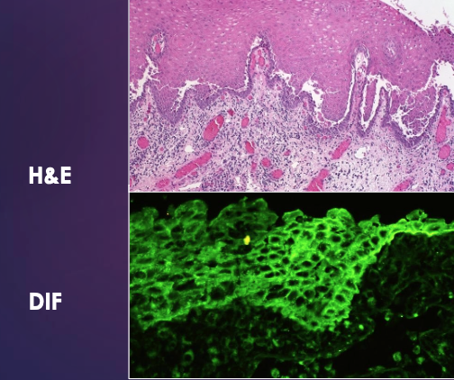 <p>What type of epithelial separation is seen in Pemphigus Vulgaris?</p>