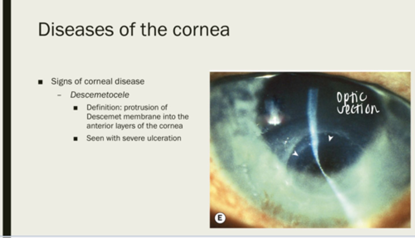<p>protrusion of Descemet membrane into the anterior layers of the cornea</p>