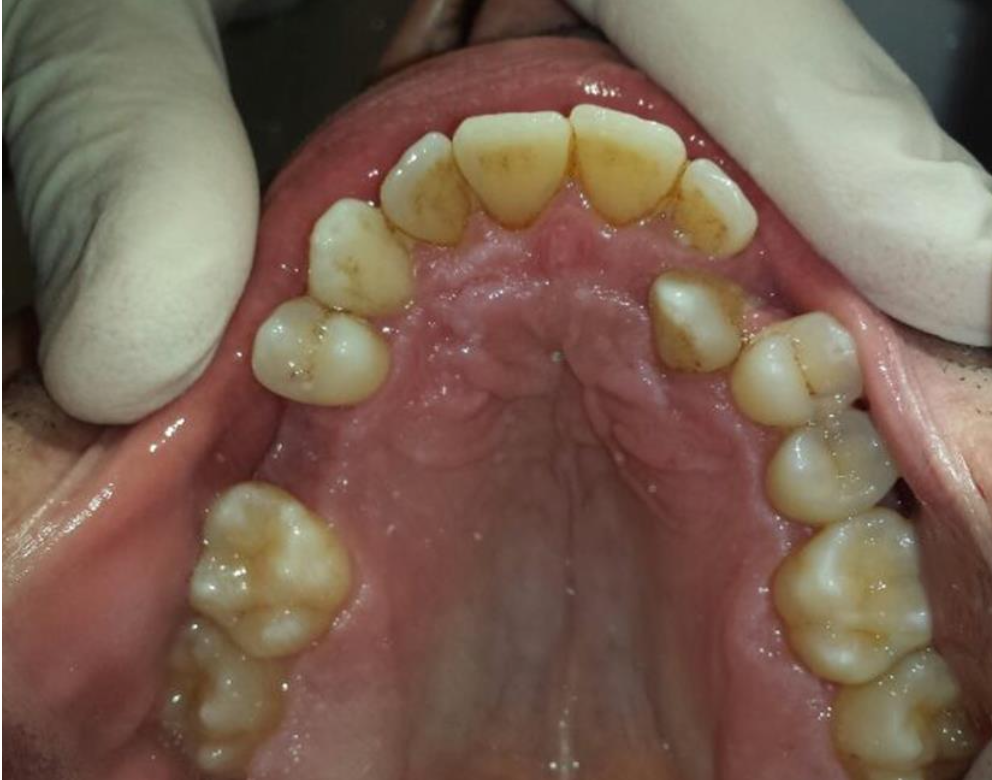 <p>What is the missing tooth ? (in every notation)</p>