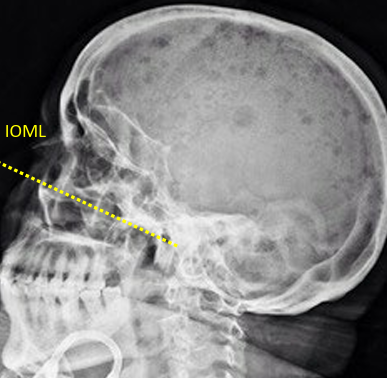 <ul><li><p>F/E: manibular rami SI anterior arch of C1</p><ul><li><p>excessive: posterior cranium SI on the posterior arch of C1</p></li></ul></li><li><p>Tilt: separation of the orbital roofs inf/sup (sharper vs. duller)</p></li><li><p>Rotation: ant/post SI of EAM, mandibular rami, greater wings, cranial cortices&nbsp;</p></li></ul><p></p>