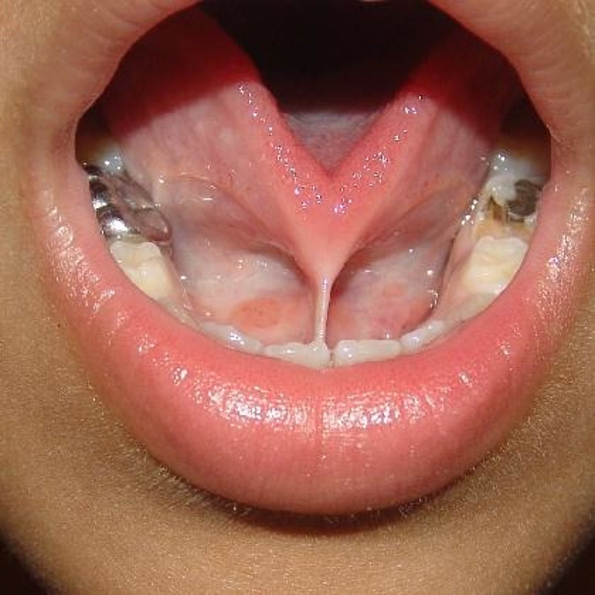 <p>Abnormally short lingual frenulum restricting tongue movement (tongue tied)</p>