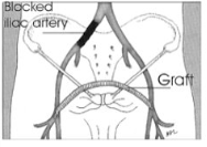 <p>bypass 1 iliac artery stenosis/occlusion</p><p>1 iliac artery supplies both legs</p>