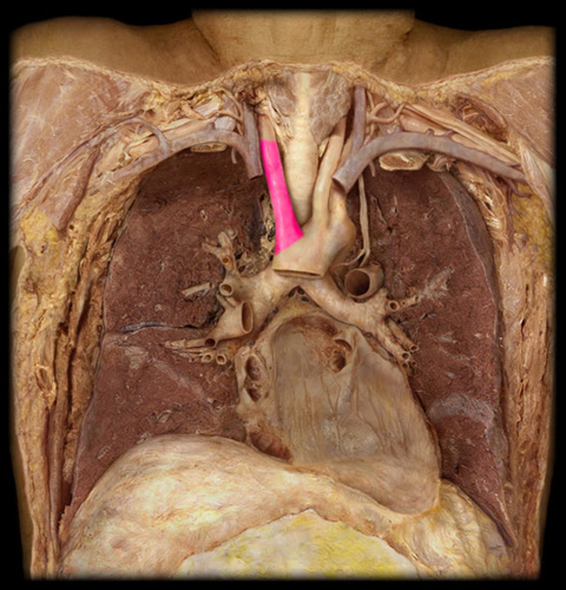 <p>first branch off aorta on pt's R</p>