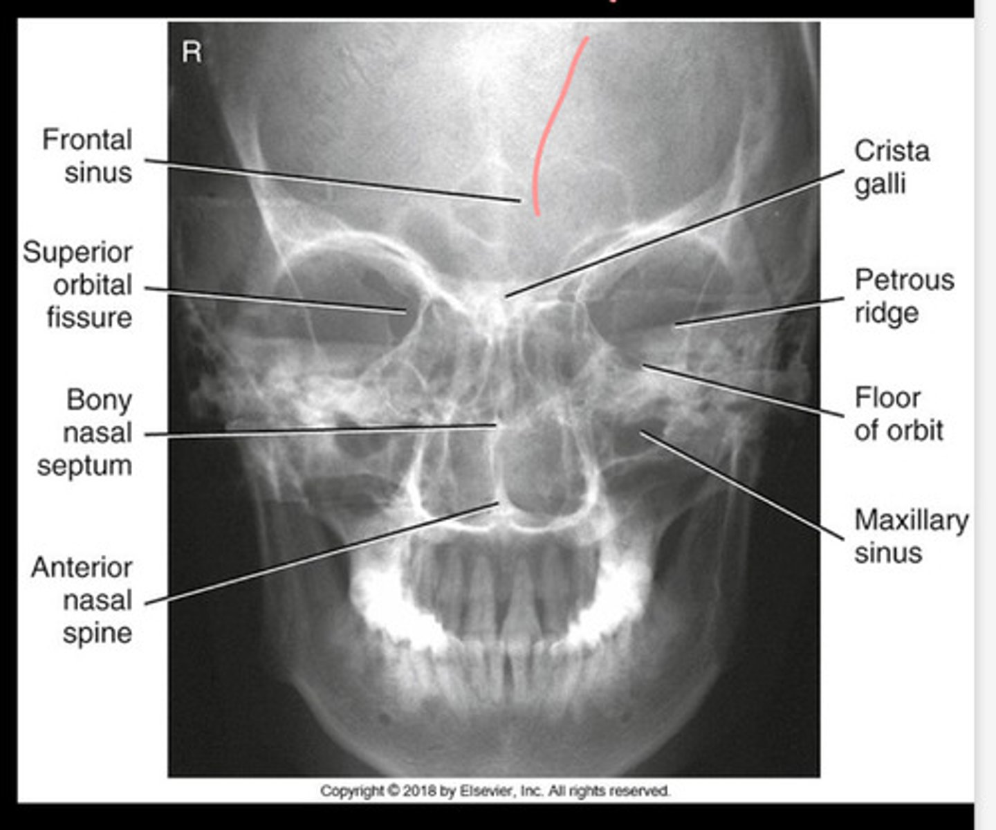 <p>frontal sinus</p><p>anterior ethmoid sinuses</p>
