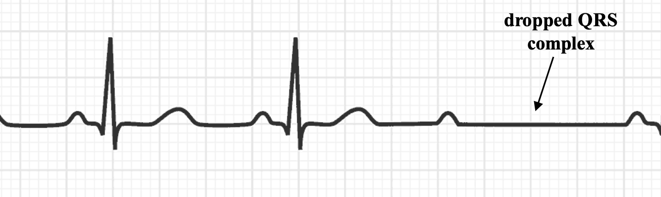 <p>Constant PR interval with intermittently dropped QRS complexes.</p>