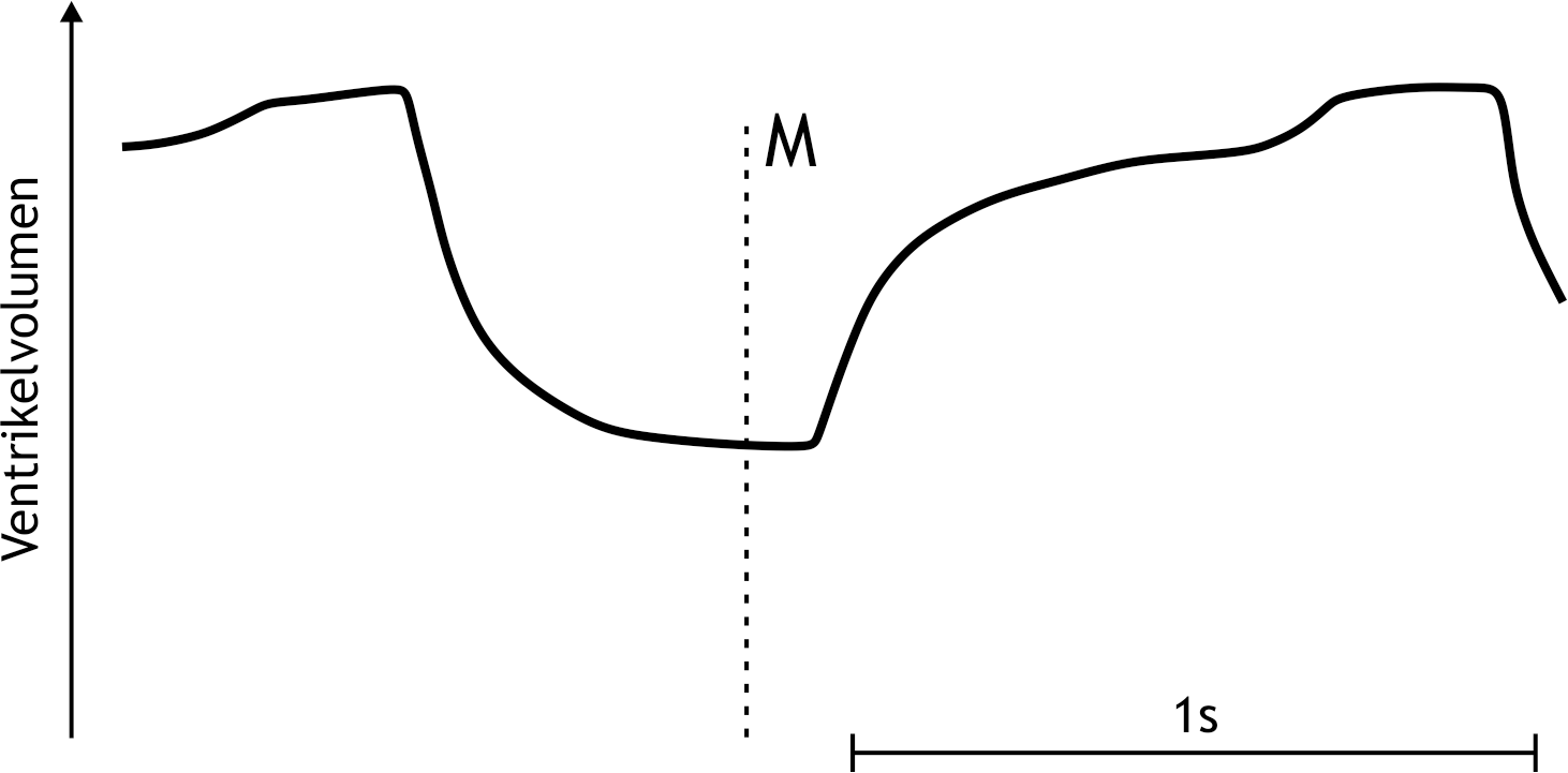 <p>39. Echocardiography is one of the most common noninvasive diagnostic methods used to assess cardiac function. During such an echocardiographic examination, the volume change of the left ventricle over time was recorded.</p><p>The position of the time marker M (dashed line) most likely coincides with:</p><p>A. Atrial contraction</p><p>B. The first heart sound</p><p>C. The beginning of isovolumetric contraction of the left ventricle</p><p>D. The end of the T wave in the ECG</p><p>E. The end of isovolumetric relaxation of the left ventricle</p>
