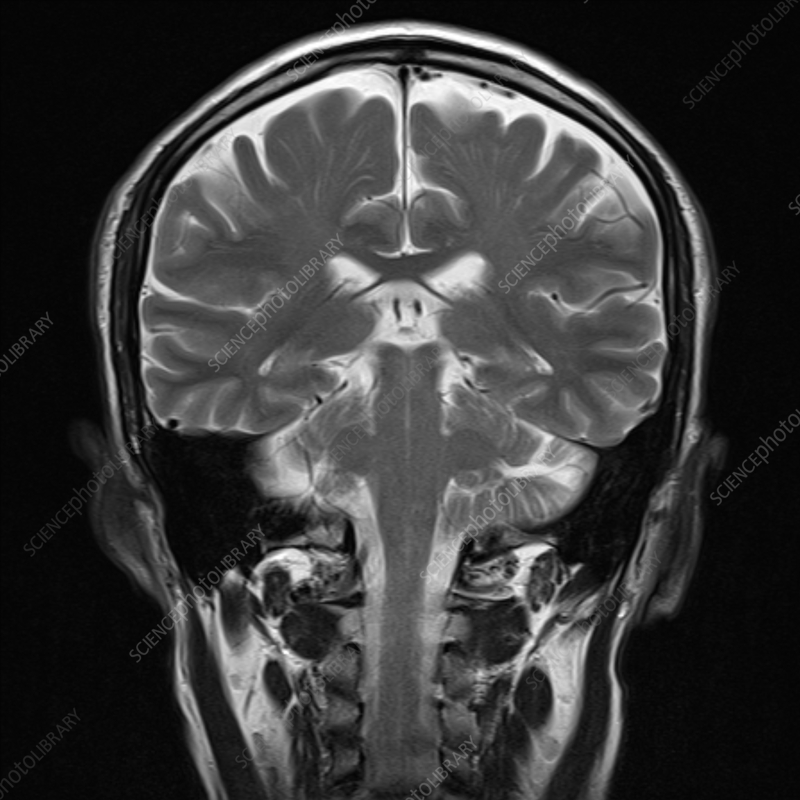 <p>a plane of dissection that divides through the brain’s dorsal and ventral sides</p>