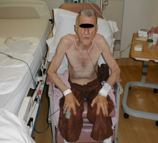 <p>barrel chest</p>