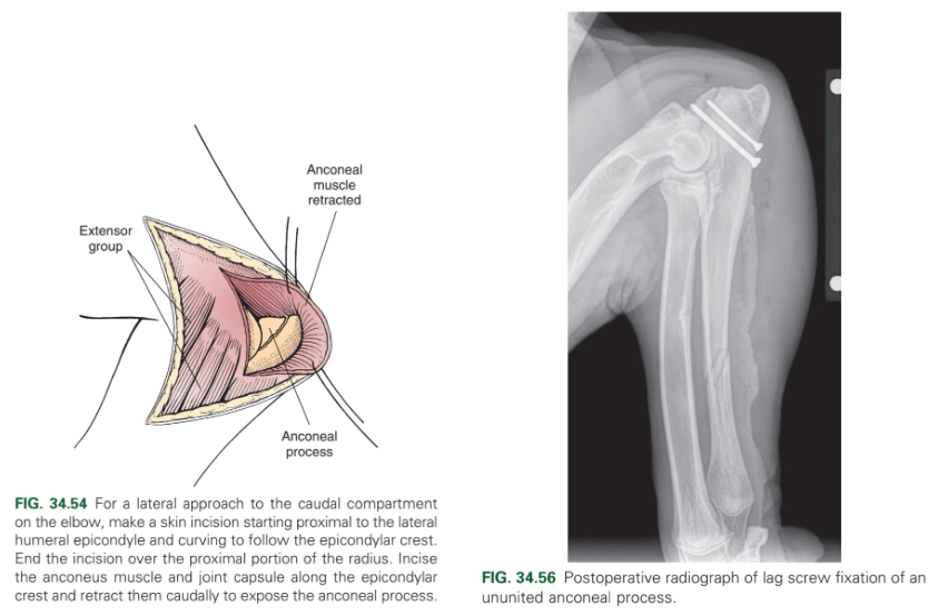 <ol><li><p>Surgical excision of anconeal process → screw fixation (lag screw)</p></li><li><p>Ulna osteotomy (lengthening osteotomy of the proximal ulna to reduce pressure of the anconeal process).</p></li></ol><p></p>
