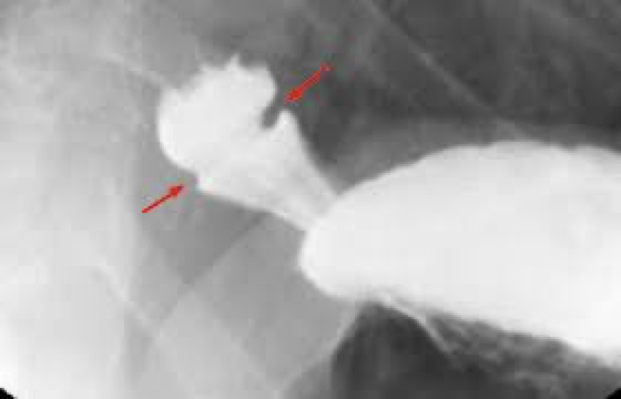 <p>Narrowing- tissue forms a ring inside the esophagus</p><p>Close to cardiac sphincter</p><p>Usually associated with HH</p>