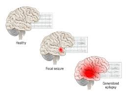 <p>Which of the following clients may be experiencing a sensory focal seizure that has sent</p><p>an abnormal cortical discharge to the autonomic nervous system (ANS)?</p><p>A) A 44-year old patient complaining of constant movement and pain in the legs that gets worse when he tries to sleep</p><p>B) An 85-year-old patient experiencing drooping of the right side of the face and numbness in the right arm and leg</p><p>C) A 56-year-old complaining of tingling sensations and has both an elevated pulse and BP</p><p>D) A 22-year-old complaining of a stiff neck and achiness, along with some nausea and vomiting</p>