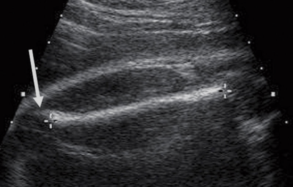 <ul><li><p>elongate femur as much as possible</p></li><li><p>ends of bone should be blunt</p></li><li><p>measure diaphysis of femur—shaft only (do not include epiphyses)</p><ul><li><p>arrow in image= distal femoral epiphysis and articular cartilage</p></li></ul></li></ul>