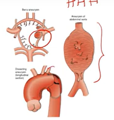 <p>localized dilation of vessel/cardiac chamber</p><ul><li><p>weakened artery via stretches</p></li><li><p>Ruptures &amp; hemorrhage</p></li><li><p>clot formation</p></li></ul><p></p>