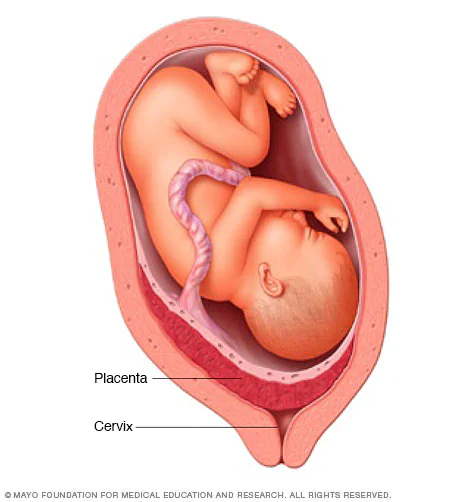 <p>placenta previa</p>