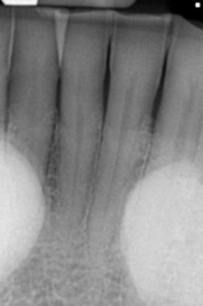 <p>Patient presents with a dense, bilateral oval radiopaque shadows that superimposed over the roots of the mandibular premolar teeth. Patient opens their mouth and the etiology is visible. What is the diagnosis?</p>