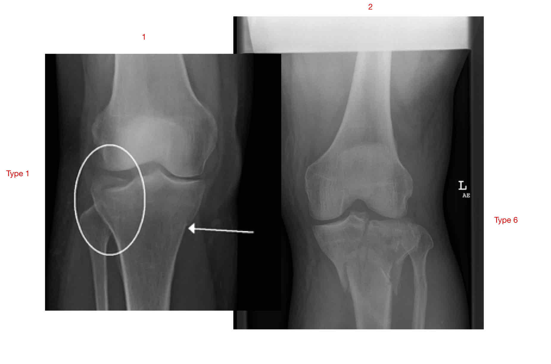 <p>Knee: Tibial Plateau Fx</p><ul><li><p>What type Tibial Plateau Fx are these:</p><ul><li><p>1</p></li><li><p>2</p></li></ul></li></ul><p></p>